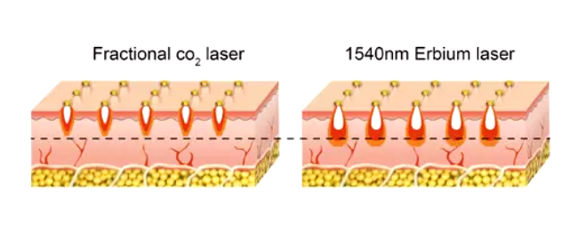 Erbium Laser gegenüber CO2 Laser